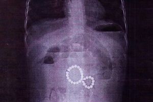 Двухлетняя девочка в Иркутске проглотила 29 магнитных шариков